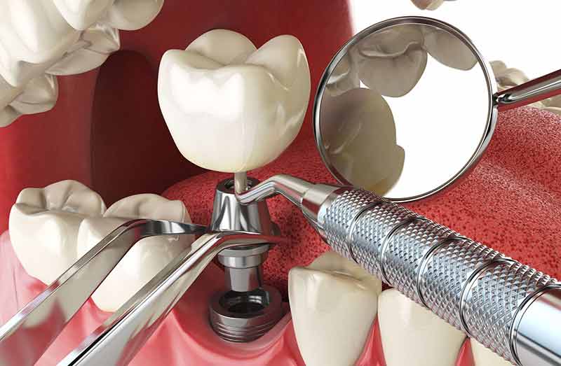 Dental Implants Prescott