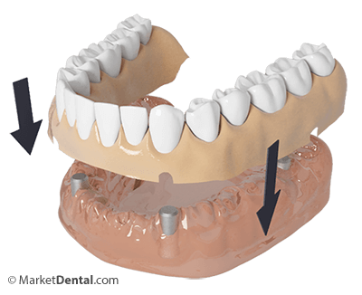 Dentures Prescott