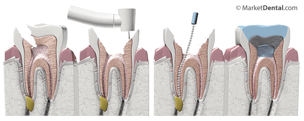 Root Canal Treatment Prescott